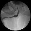 Distal Bulbar Urethral Stricture and Brachytherapy Seeds