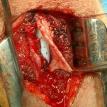 Buccal Mucosa Graft Urethroplasty