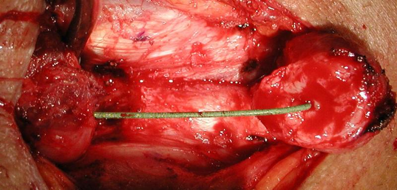 Anastomotic Urethroplasty