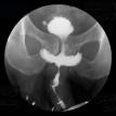 Brachytherapy Prostate Defect
