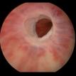 Bulbar Urethral Stricture