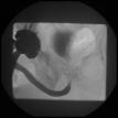 Prostatic Urethral Stricture after Brachytherapy