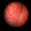 Radiation Cystitis