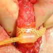 Artificial Sphincter Cuff