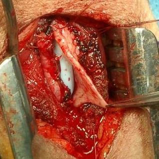 Buccal Urethroplasty